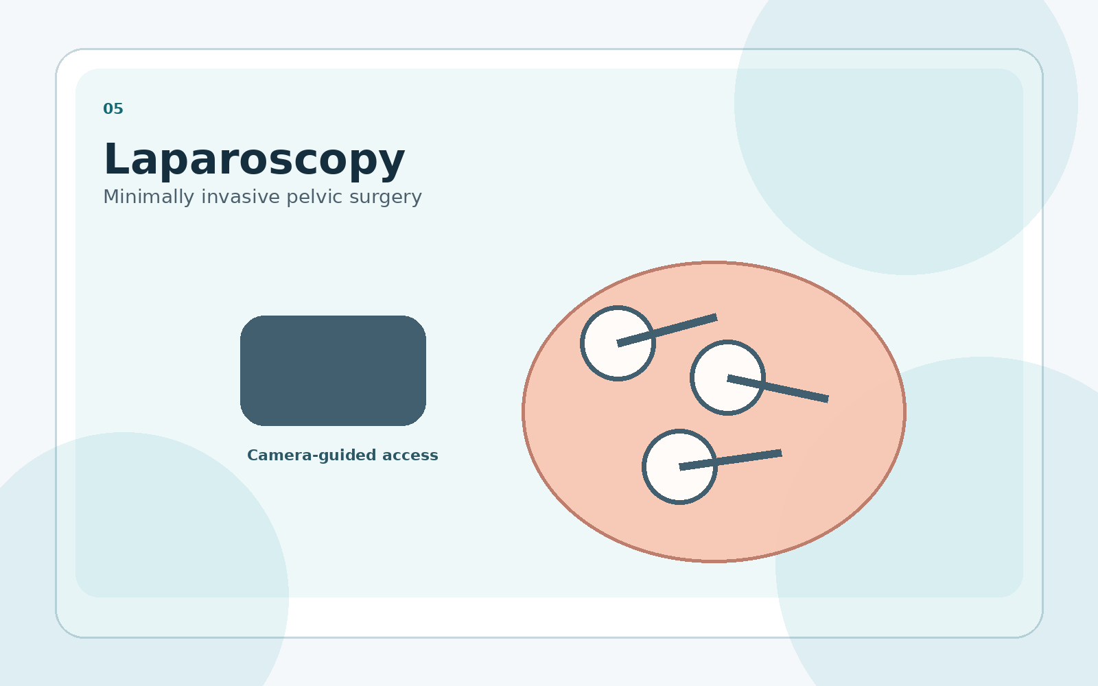 Laparoscopy procedure